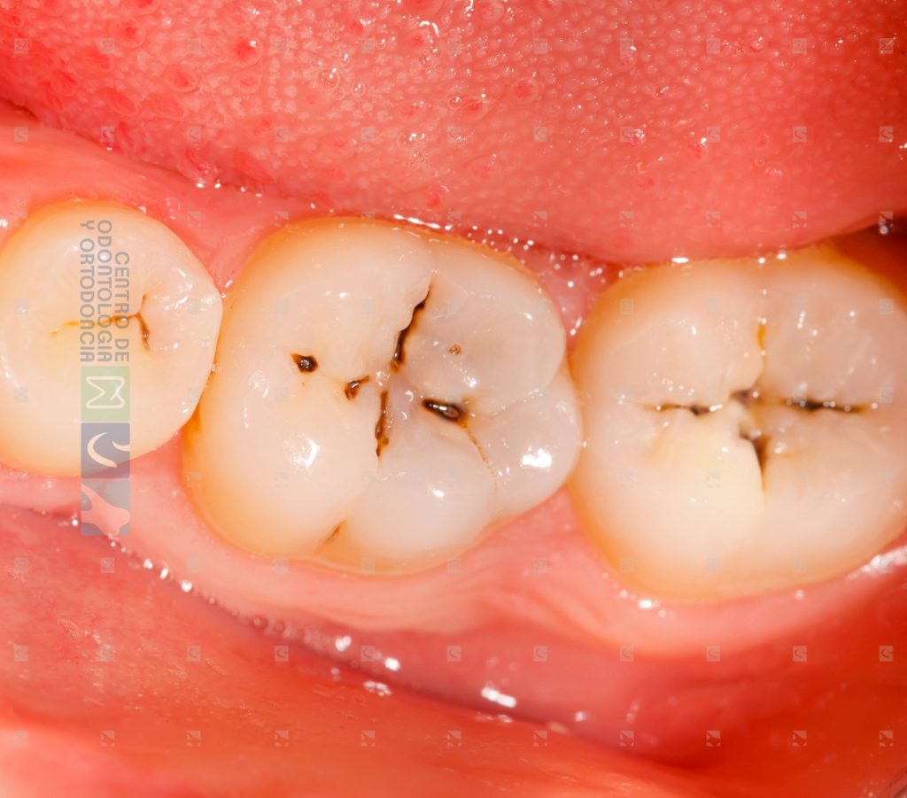 RESTAURACIONES PEQUEÑAS PARA TAPAR CARIES