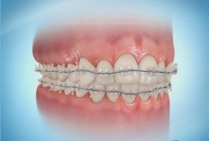 Tratamiento de Ortodoncia