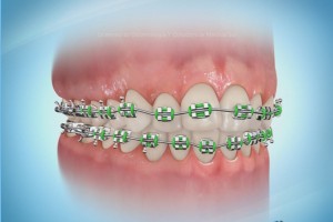 Tratamiento de Ortodoncia