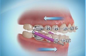 Aparatos en ortodoncia